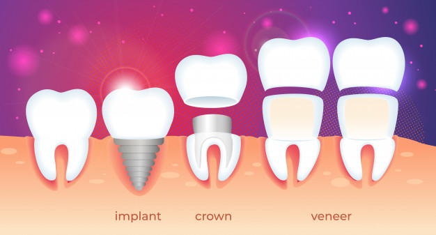 perbedaan implan crown dan veneer gigi