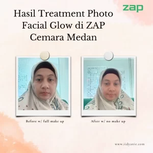 Hasil treatment photo facial glow zap cemara medan kulit tampak bersih merona